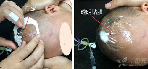 小儿头皮静脉穿刺视频,小儿头皮静脉穿刺操作步骤及要点解析